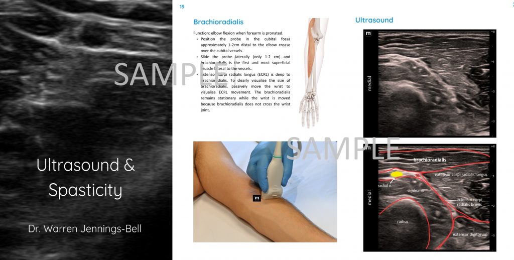 Ultrasound & Spasticity SAMPLE